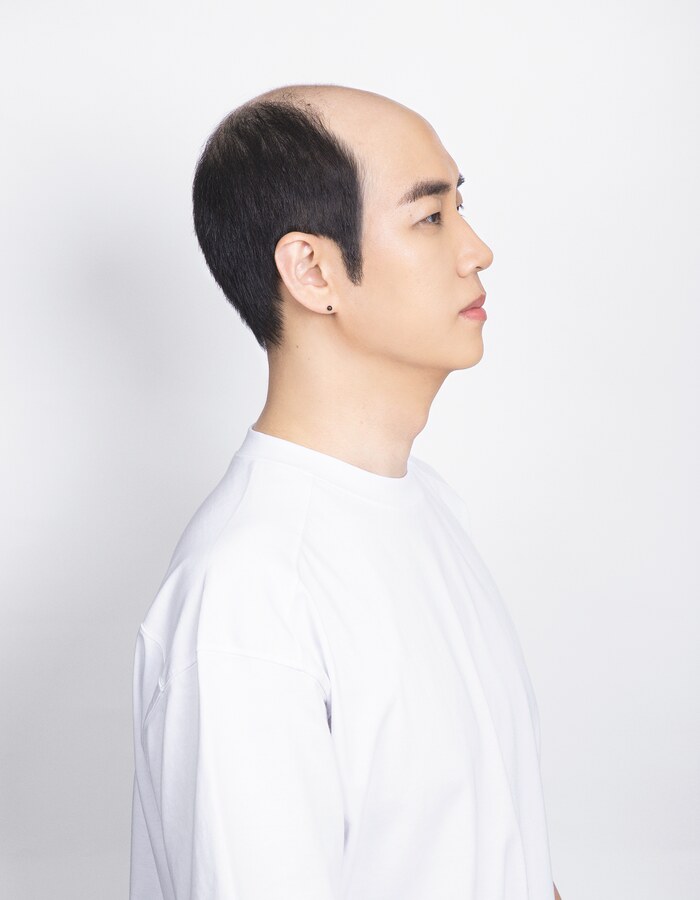 탈모 측면